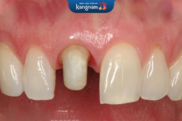 Bọc răng sứ có đau không