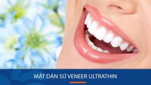 Mặt dán sứ veneer ultrathin có đắt không? Dán loại nào tốt