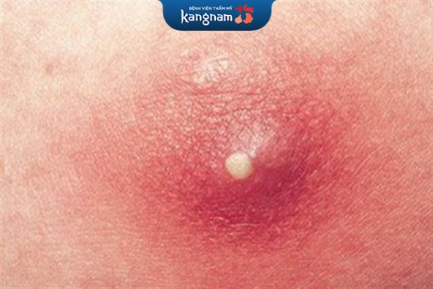 Mụn ở mông ảnh hưởng đến sinh hoạt hàng ngày, gây cảm giác khó chịu