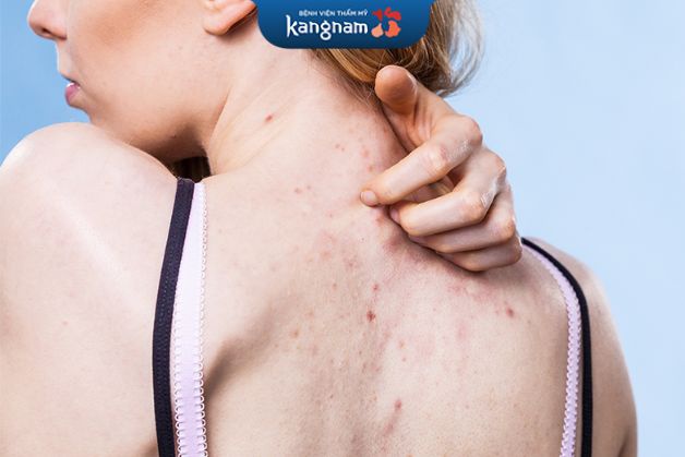 Xác định nguyên nhân để có cách điều trị mụn lưng hiệu quả
