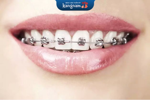 Niềng mắc cài truyền thống được nhiều người lựa chọn