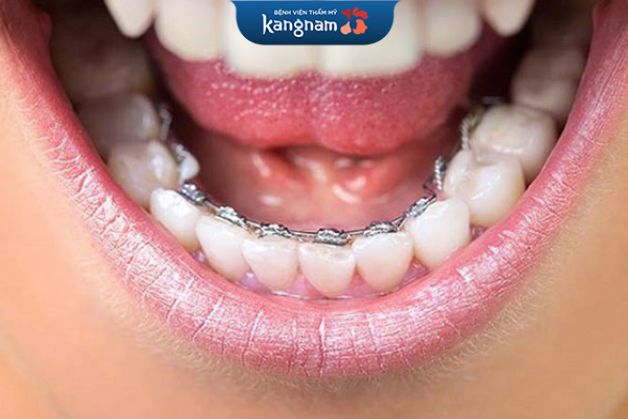 Niềng mắc cài kim loại mặt trong ít bị lộ hơn