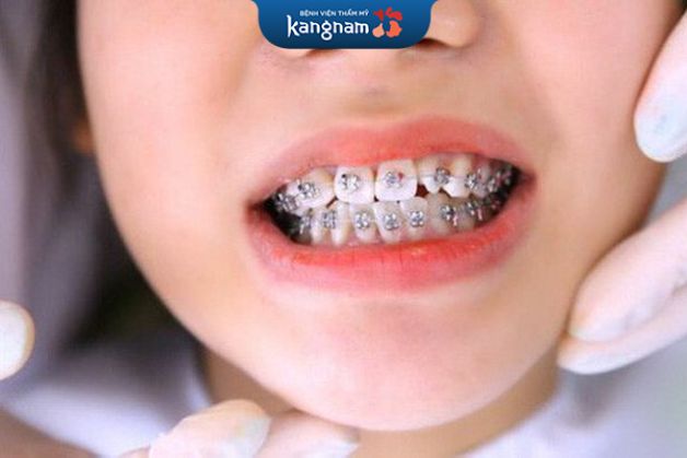 Niềng răng tại Kanngam nhanh chóng, hiệu quả