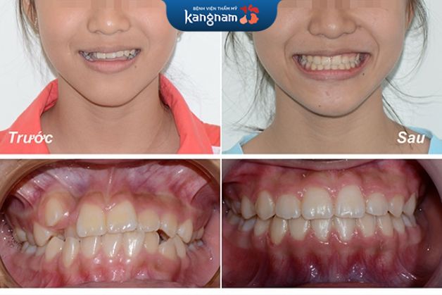 Cải thiện răng khấp khểnh hiệu quả