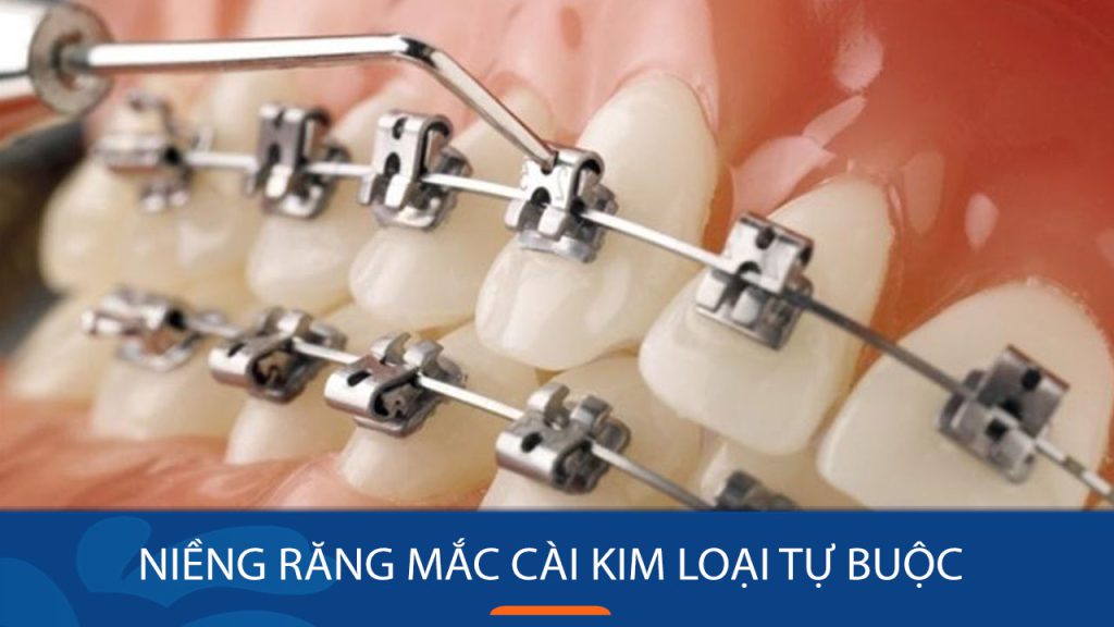 Niềng răng mắc cài kim loại tự buộc: Ưu – Nhược điểm?