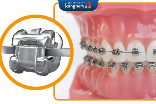 niềng răng mắc cài kim loại tự buộc rất tiện dụng