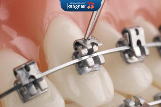 Mắc cài kim loại tự buộc là gây khó chịu cho người dùng vì độ dày lớn và có chi phí khá cao