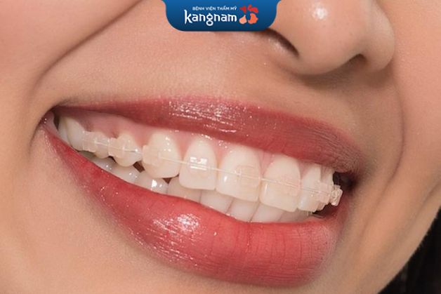 Chỉnh nha bằng mắc cài pha lê chính là phiên bản cải tiến hơn từ mắc cài kim loại