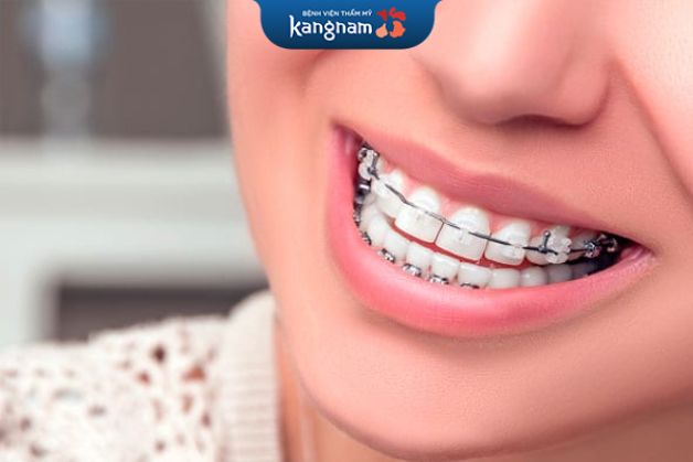 Thanh trượt trong mắc cài thay thế cho chun chỉnh nha hỗ trợ quá trình niềng răng diễn ra xuyên suốt