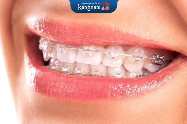 Mắc cài sức hỗ trợ tốt cho quá trình vệ sinh