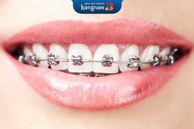 Niềng răng mắc cài tự đóng ít gây đau