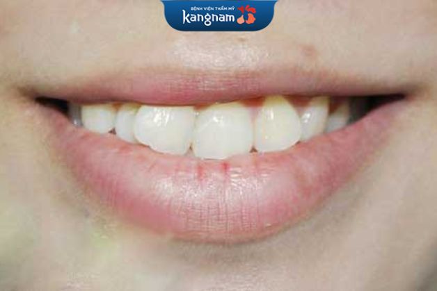 Niềng răng tháo lắp khi răng lệch lạc nhẹ