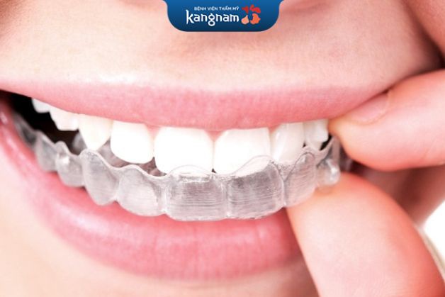 Bảng giá niềng răng tháo lắp