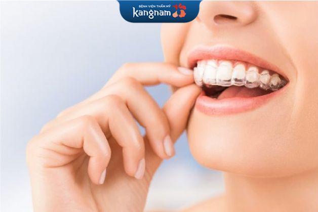 Niềng răng trong suốt khi răng lệch lạc nhẹ