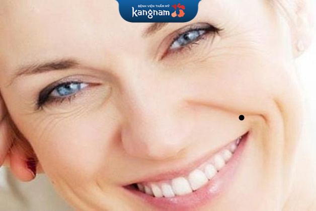 Nốt ruồi pháp lệnh không mấy tốt đẹp