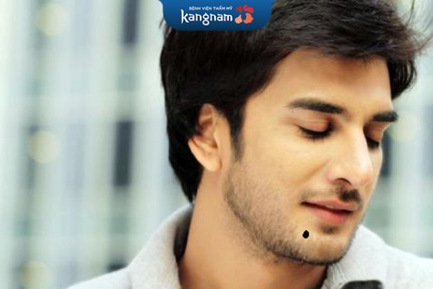 Nốt ruồi xuất ngoại