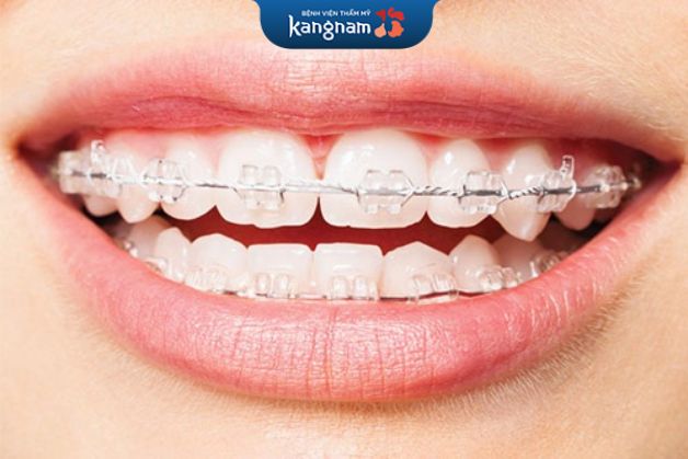 Niềng răng mắc cài sứ