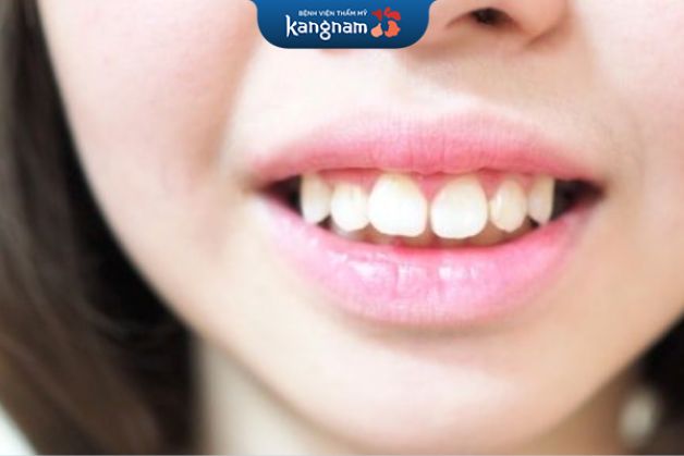 Phù hợp với người răng khấp khểnh, hô nhẹ