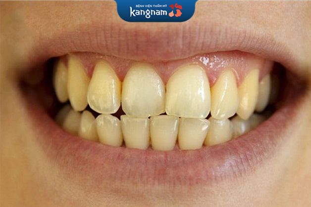 Răng sứ emax giá bao nhiêu