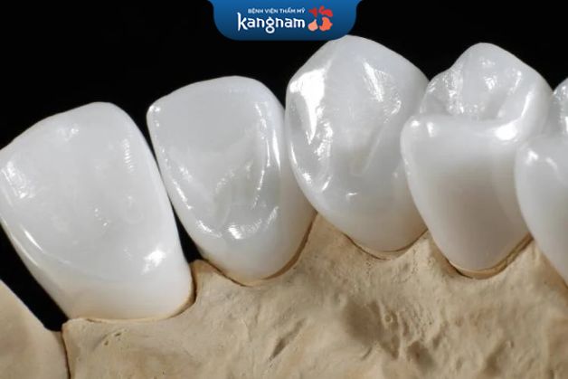 Răng toàn sứ Emax Press có giá 7 triệu đồng