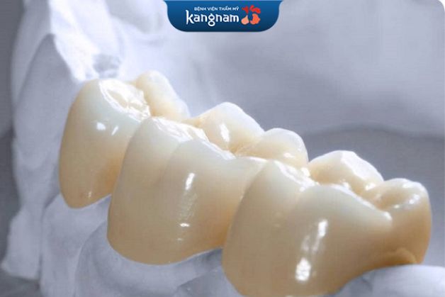 Răng sứ Roland đẹp tự nhiên, độ bền cao