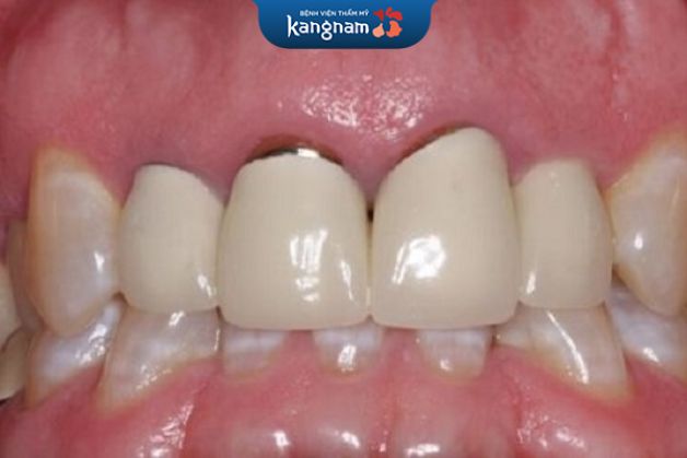 Sử dụng một thời gian, sứ titan vẫn xuất hiện tình trạng đen chân