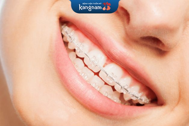 chỉnh nha mắc cài pha lê