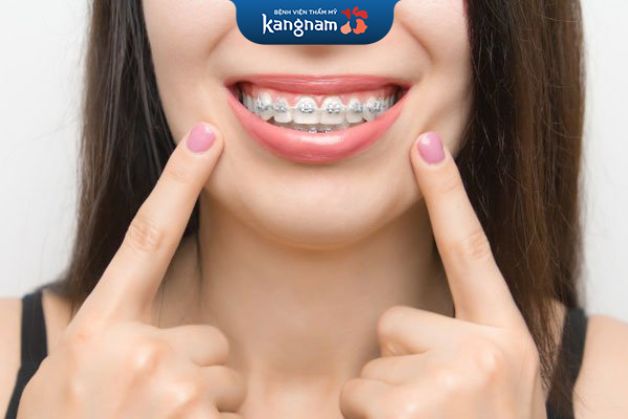 Chỉnh nha với mắc cài răng sứ thường diễn ra trong khoảng từ 18-24 tháng