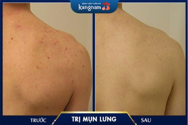 Loại bỏ đến 90% các loại mụn nhờ ánh sáng nano