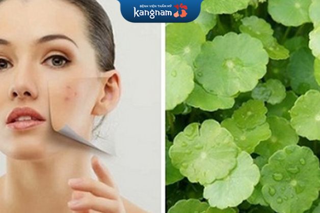 Trị sẹo thâm lâu năm ở mặt bằng rau má