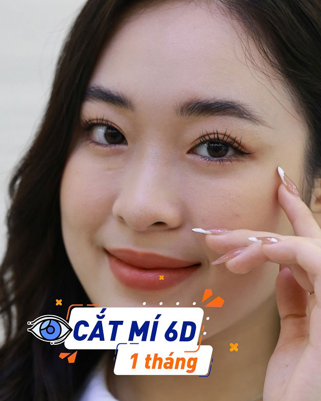 Khách hàng cắt mí 6D 1 tháng 
