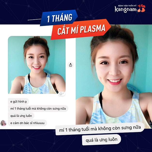 Cảm nhận của khách hàng sau khi cắt mí được 1 tháng tuổi