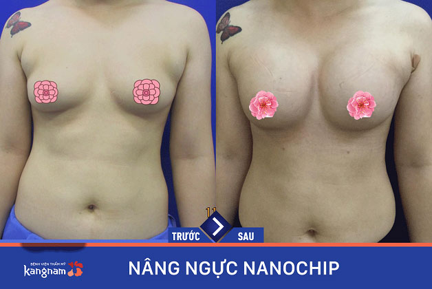 Sẹo đã hoàn toàn biến mất mang lại kết quả đẹp nhất