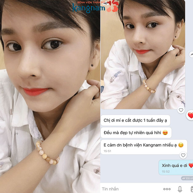 Khách hàng chia sẻ cảm nhận sau khi cắt mí tại Kangnam