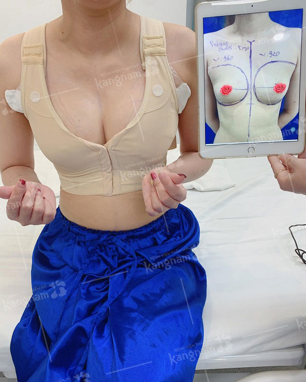 Khách hàng sau khi nâng ngực 6D