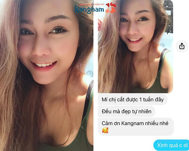 Khách hàng chia sẻ cảm nhận sau khi cắt mí được 1 tuần