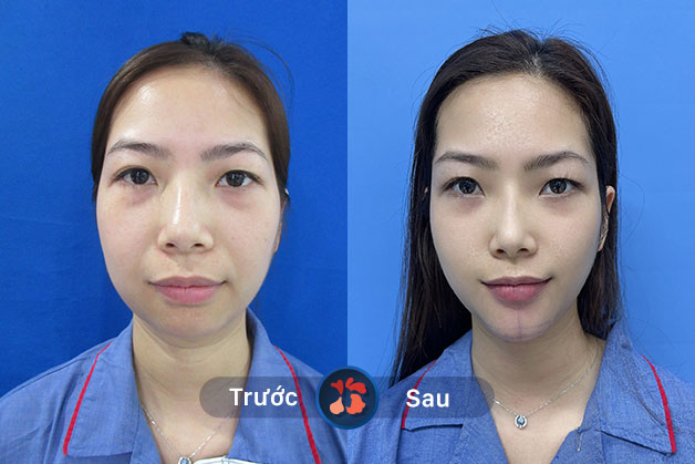 Khắc phục khuyết điểm để gương mặt trở nên thon gọn, thanh tú