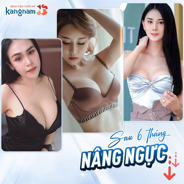 Sau 6 tháng nâng ngực, dáng ngực bền đẹp tự nhiên