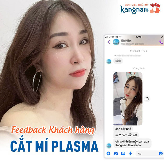 Review của khách hàng sau khi cắt mí Plasma 