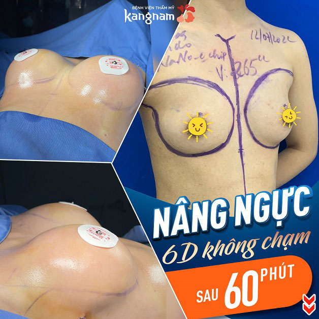 Nâng ngực 6D không chạm chỉ sau 60 phút