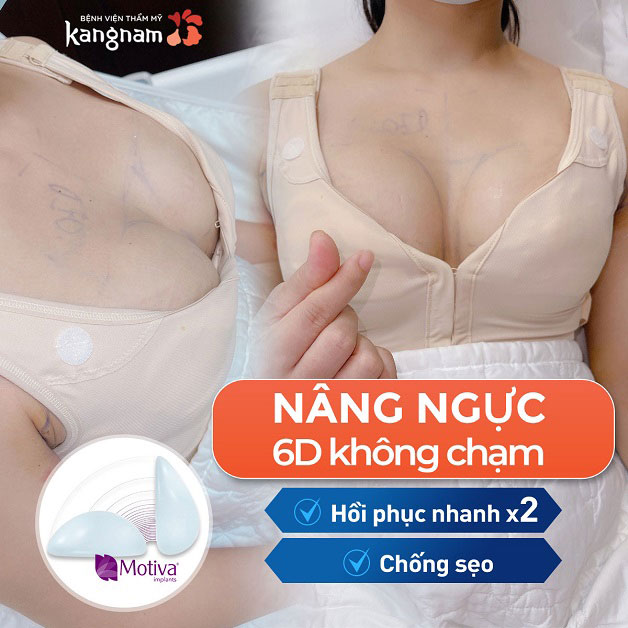Công nghệ nâng ngực 6D hạn chế sẹo xấu, hồi phục nhanh gấp 2 lần