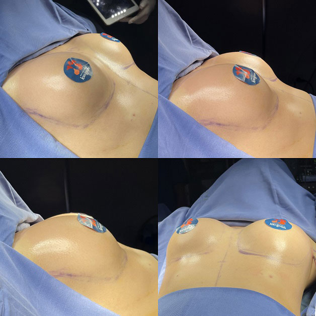 Khách hàng thực hiện thành công nâng ngực 