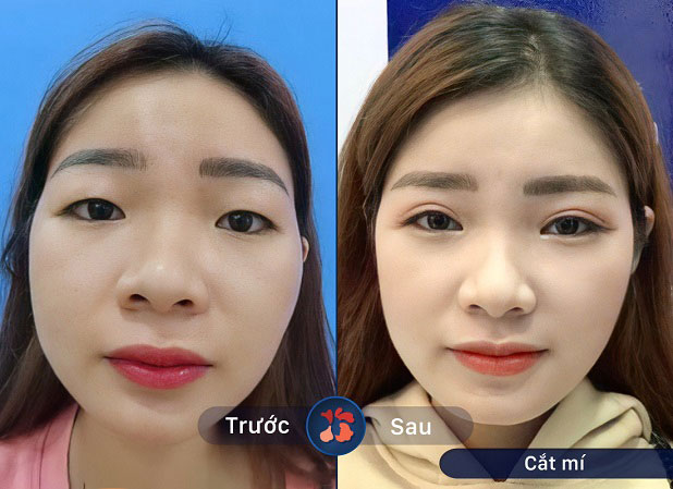 Kết quả trước và sau khi cắt mí