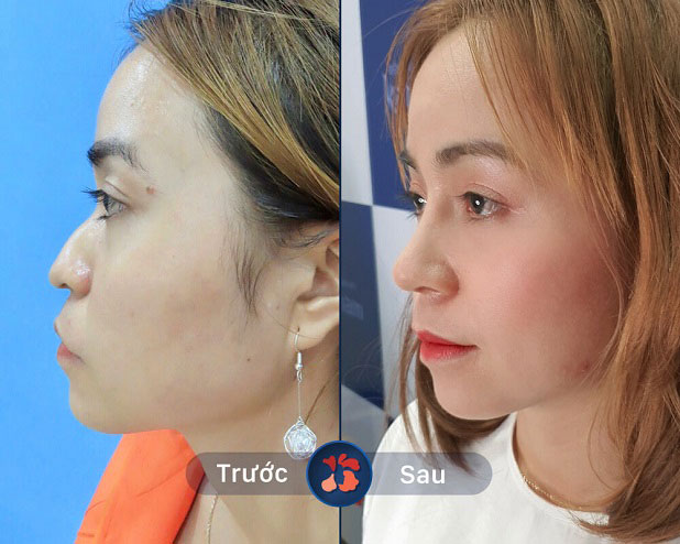 Biến hình mũi gồ ghề thành mũi cao tây thanh thoát