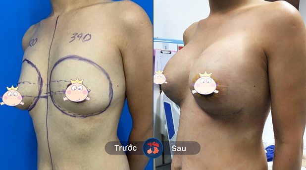 Vòng 1 thay đổi sau khi nâng ngực