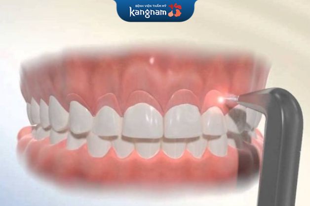 Cắt nướu bằng tia laser là phương pháp hiệu quả và được nhiều chuyên gia khuyến khích