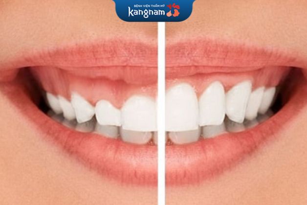 Cắt nướu không đau đớn vì đã được gây tê