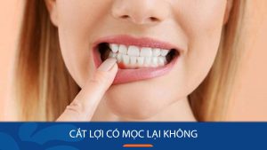 Cắt lợi có mọc lại không? Những biến chứng nguy hiểm