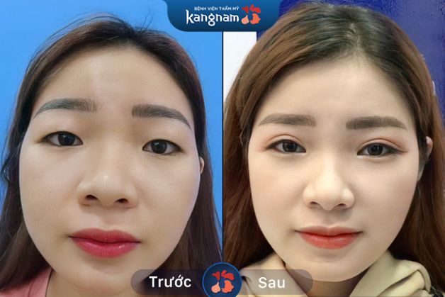 Cắt mí chuẩn tỷ lệ, cân xứng 2 bên và nâng tầm nhan sắc hiệu quả