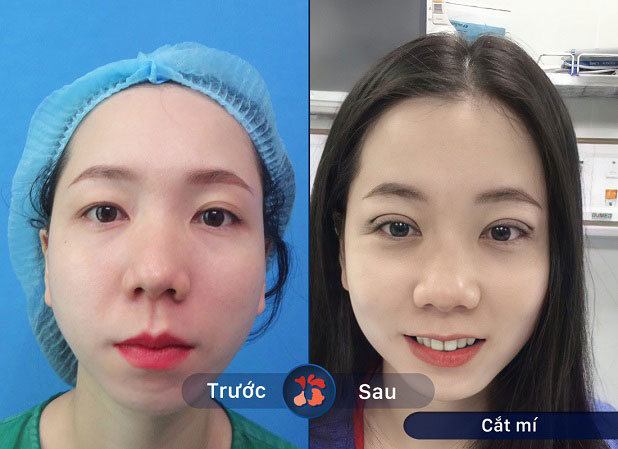 Đường mí đẹp tự nhiên như thật, giúp đường nét gương mặt nổi bật hơn